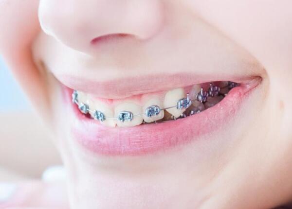 戴了牙套可以用電動牙刷嗎？戴牙套的人群必看！